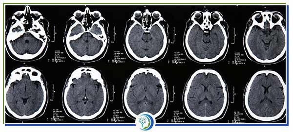 The Brain Science Behind Ketamine in Los Altos CA