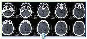 The Brain Science Behind Ketamine in Los Altos CA